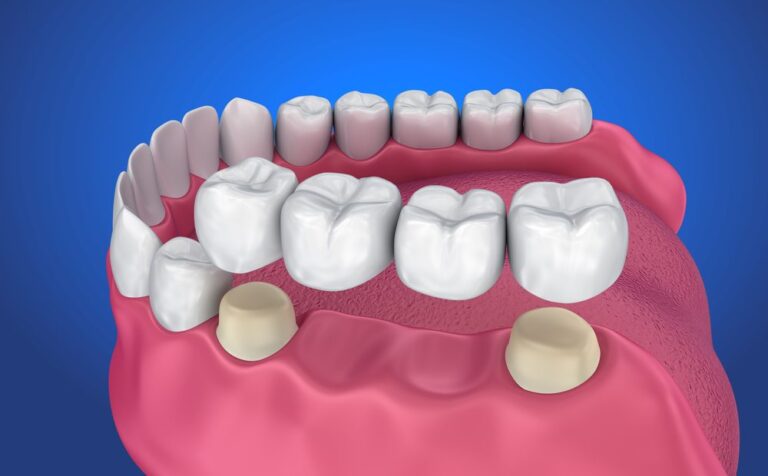 Bridges | All Smiles Dental Practice Ltd
